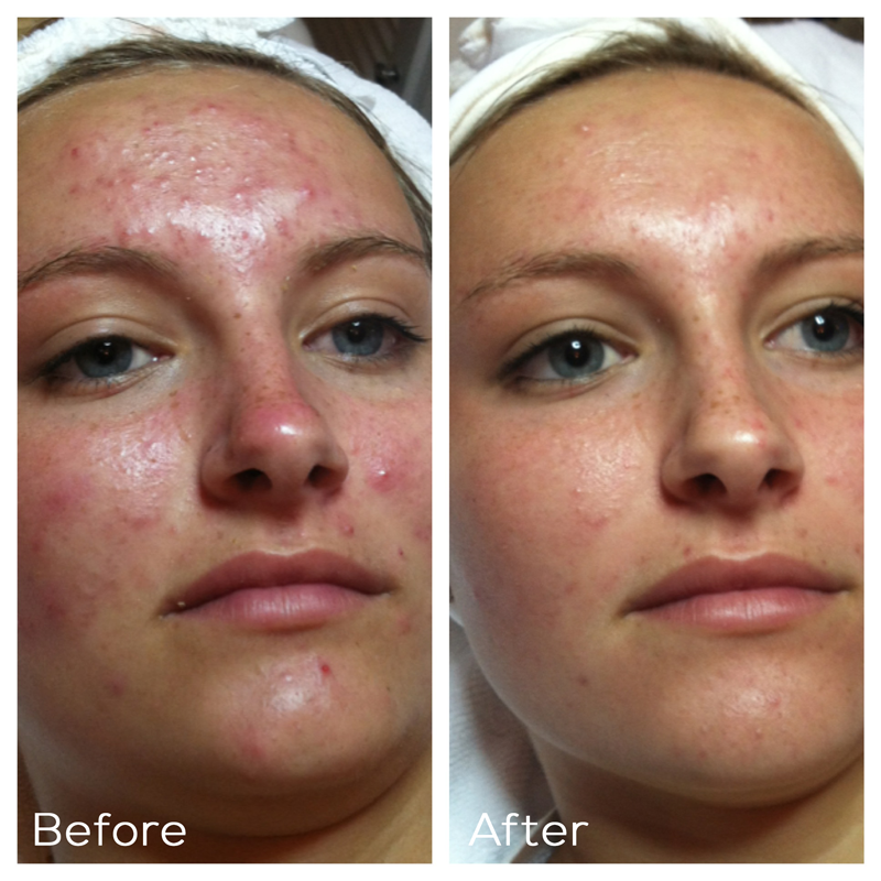 Closeup of young woman's face with severe acne on the left and much clearer on the right after HydraFacial