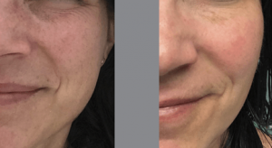 Close up of woman's cheek with sun damage on the left and clear skin on the right